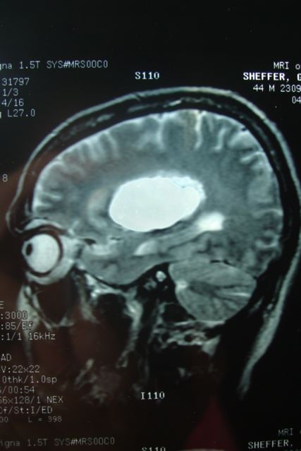Head MRI of Stroke in middle aged male 