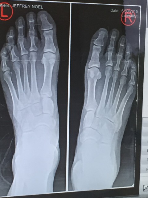 Feet x-ray