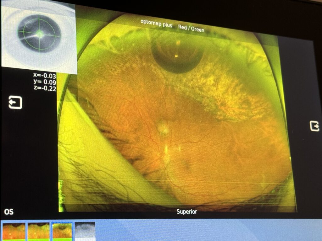 Retina photograph