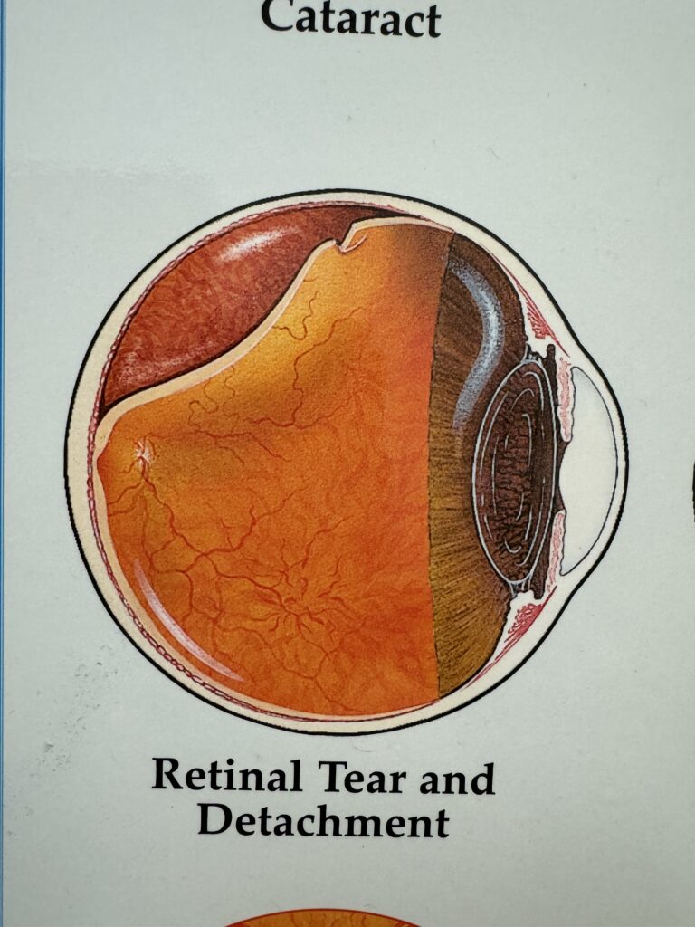 Retina tear image